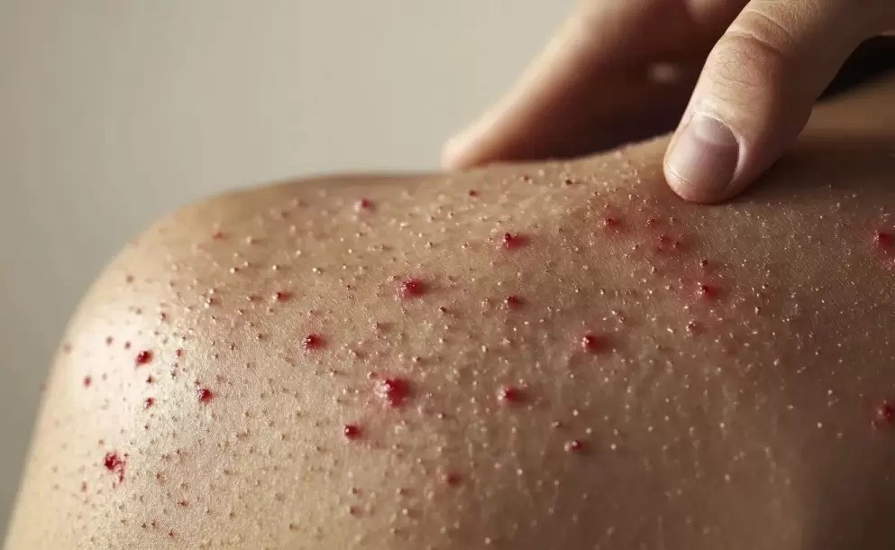 Primer caso de sarampión en Argentina en 2026: lo confirmó el Malbrán y el paciente permanece aislado