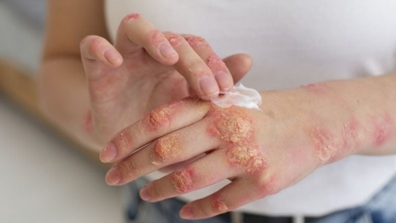 S&iacute;filis en Argentina: 46.799 casos en 2025 y una tasa de 117,2 por cada 100 mil habitantes