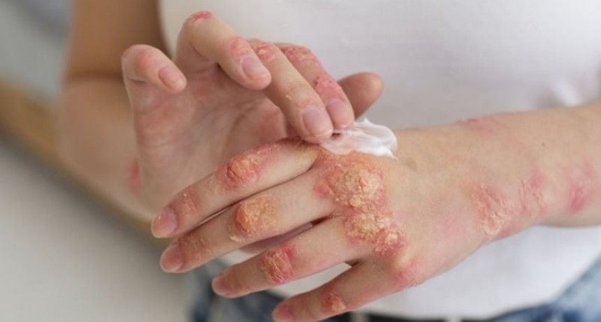 S&iacute;filis en Argentina: 46.799 casos en 2025 y una tasa de 117,2 por cada 100 mil habitantes