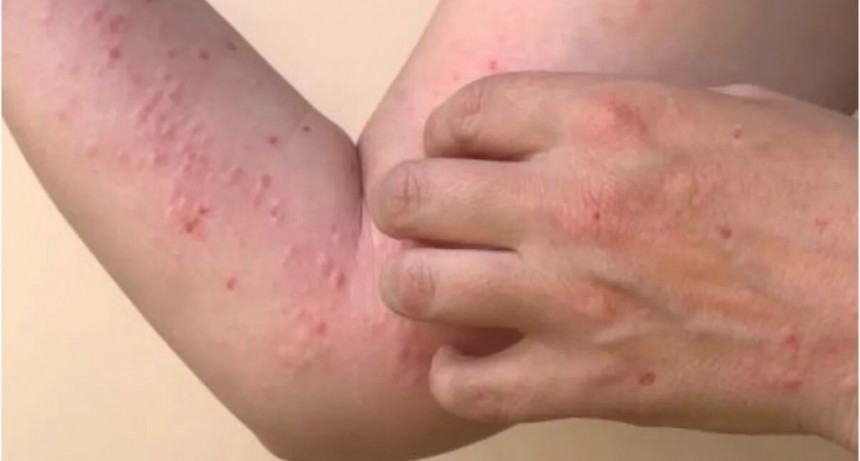 Confirman que la viruela del mono podría llegar a Tucumán