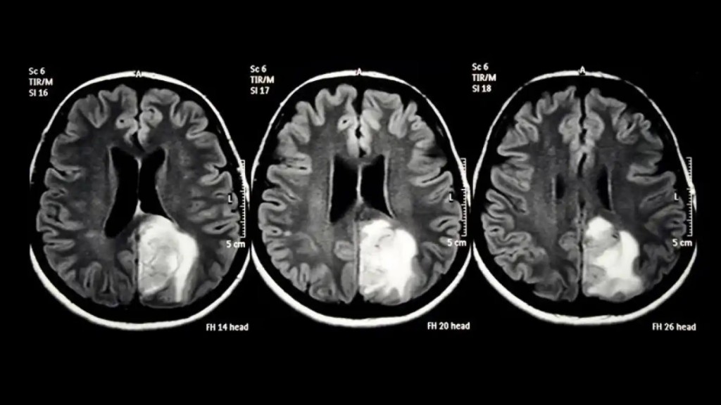 Nueva esperanza contra el tumor cerebral más agresivo