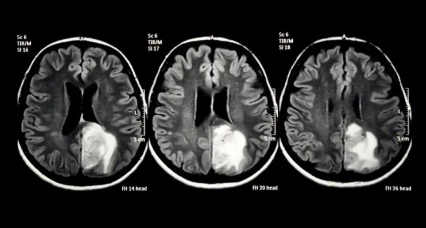 Nueva esperanza contra el tumor cerebral más agresivo