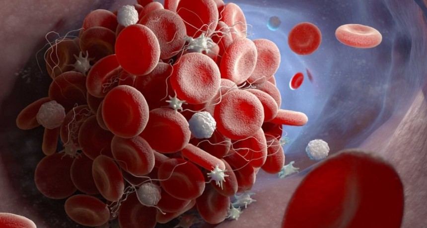 La trombosis, una amenaza silenciosa: responsable de una de cada cuatro muertes a nivel global