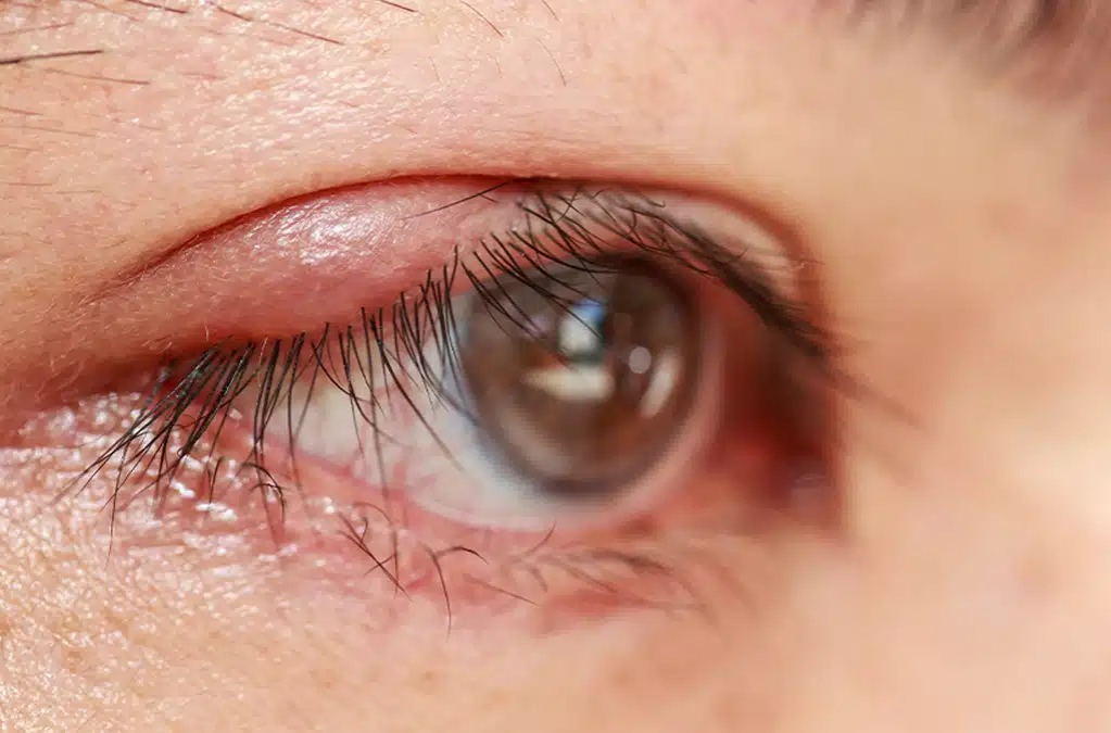 Maquillaje, estrés y alergias: los desencadenantes de los orzuelos que preocupan al sistema de salud