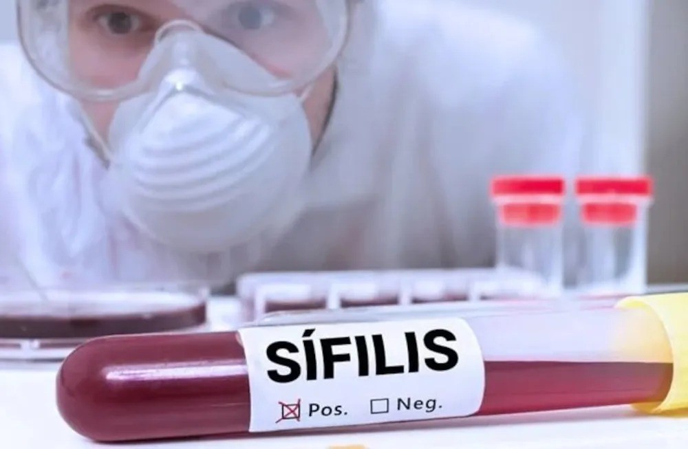 La sífilis alcanza récords históricos en Argentina con más de 36.000 casos anuales