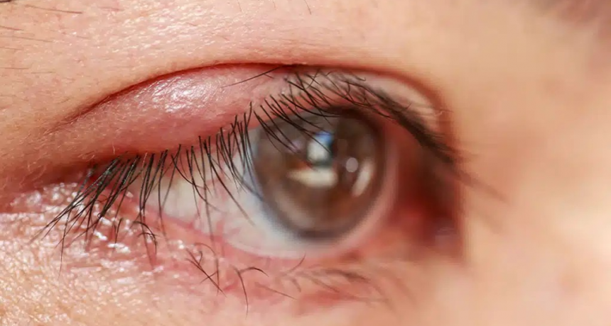 Maquillaje, estrés y alergias: los desencadenantes de los orzuelos que preocupan al sistema de salud